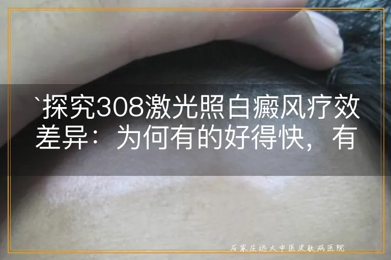 `探究308激光照白癜风疗效差异：为何有的好得快，有的慢？`