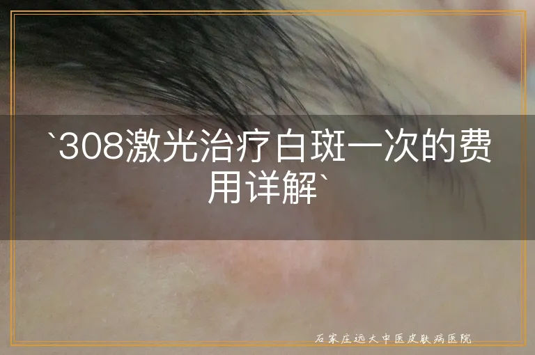 `308激光治疗白斑一次的费用详解`