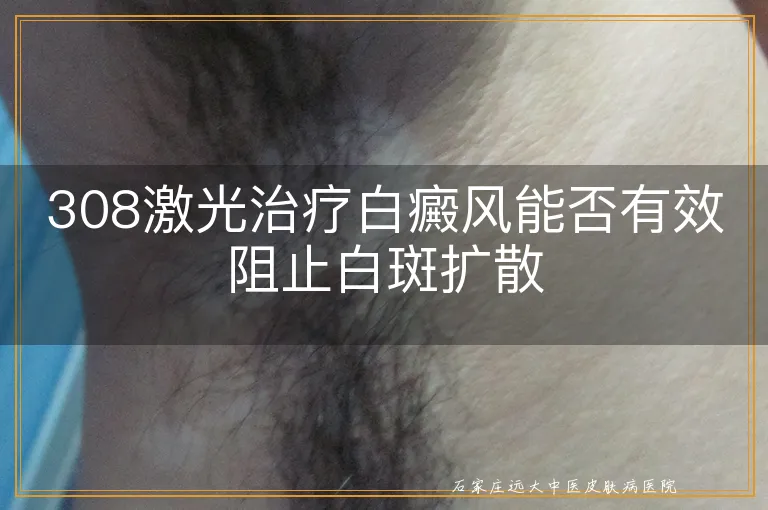 308激光治疗白癜风能否有效阻止白斑扩散