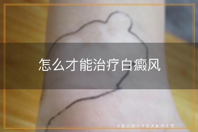 怎么才能治疗白癜风