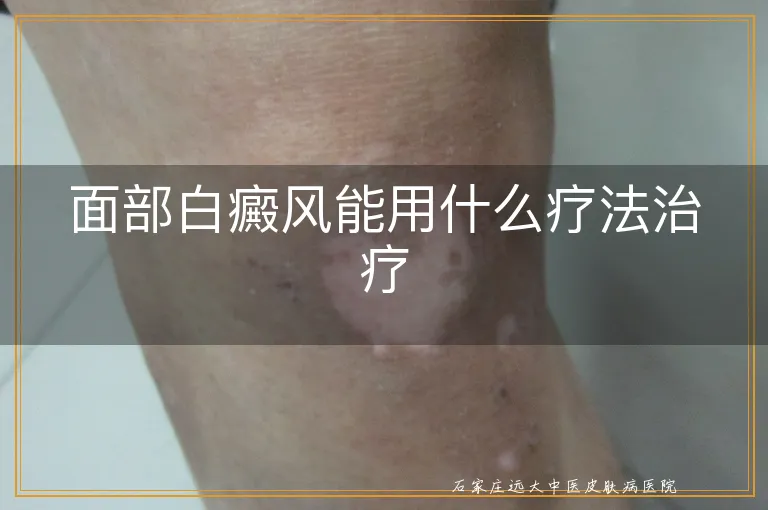 面部白癜风能用什么疗法治疗