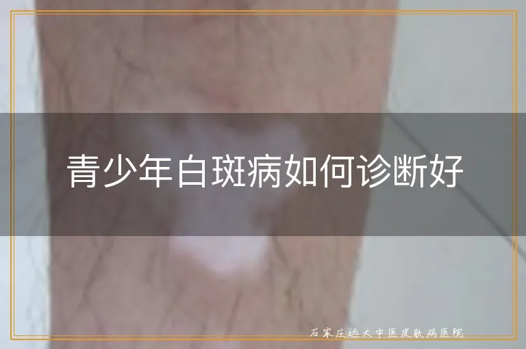 青少年白斑病如何诊断好