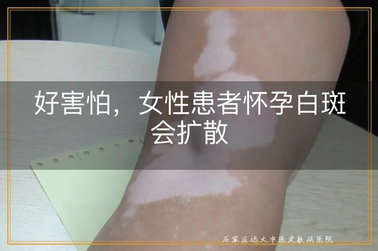 好害怕，女性患者怀孕白斑会扩散