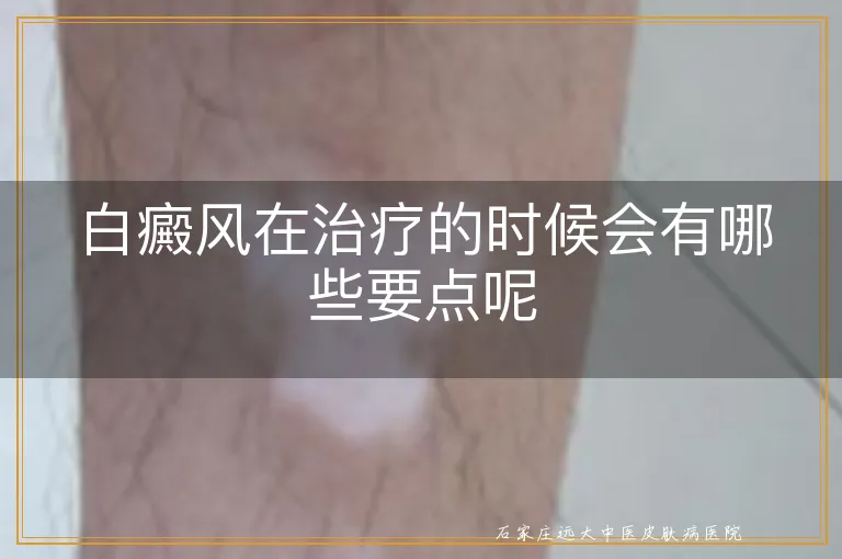 白癜风在治疗的时候会有哪些要点呢