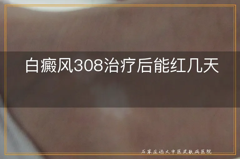 白癜风308治疗后能红几天