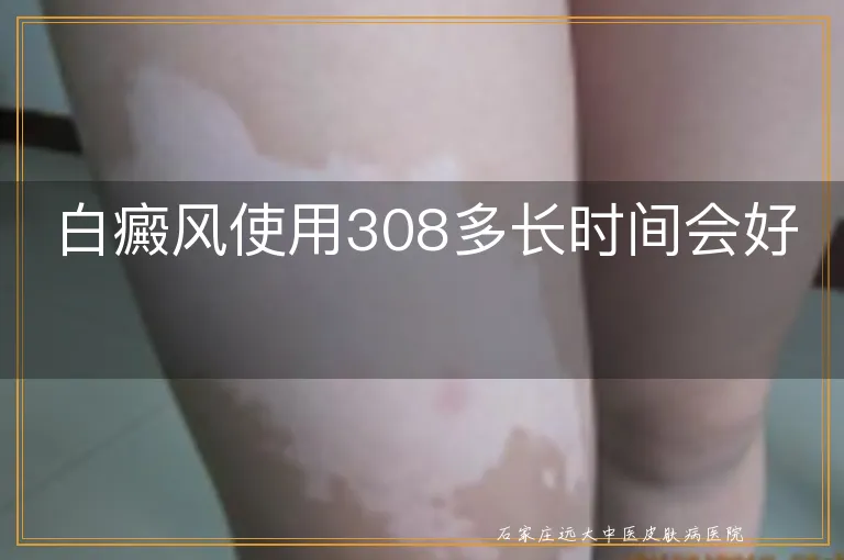 白癜风使用308多长时间会好