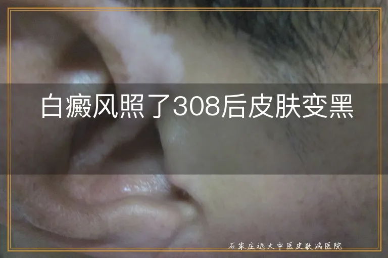 白癜风照了308后皮肤变黑