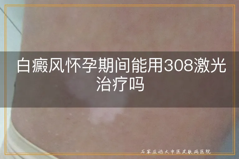 白癜风怀孕期间能用308激光治疗吗