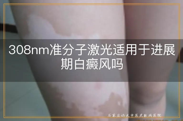 308nm准分子激光适用于进展期白癜风吗