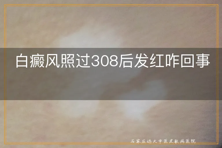 白癜风照过308后发红咋回事