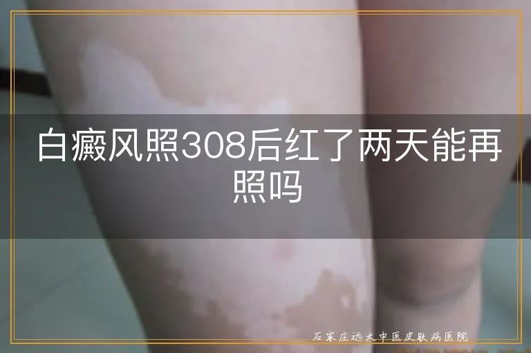 白癜风照308后红了两天能再照吗