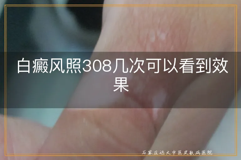 白癜风照308几次可以看到效果