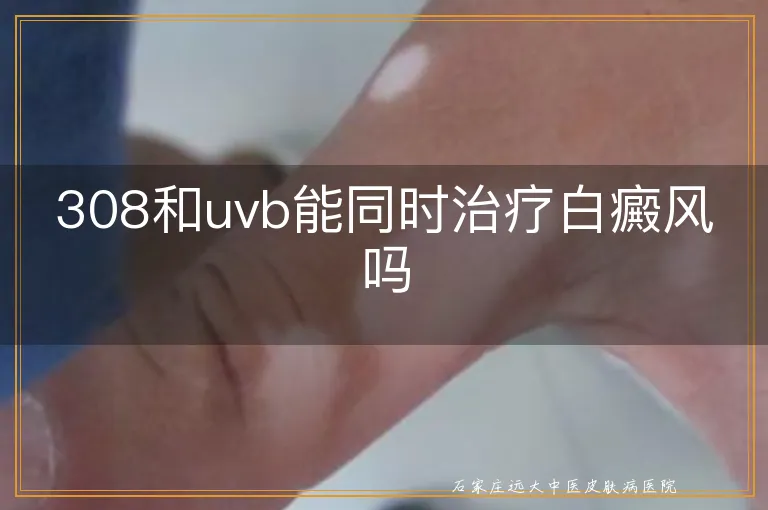 308和uvb能同时治疗白癜风吗