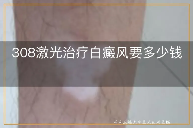 308激光治疗白癜风要多少钱