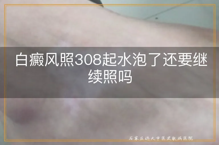 白癜风照308起水泡了还要继续照吗