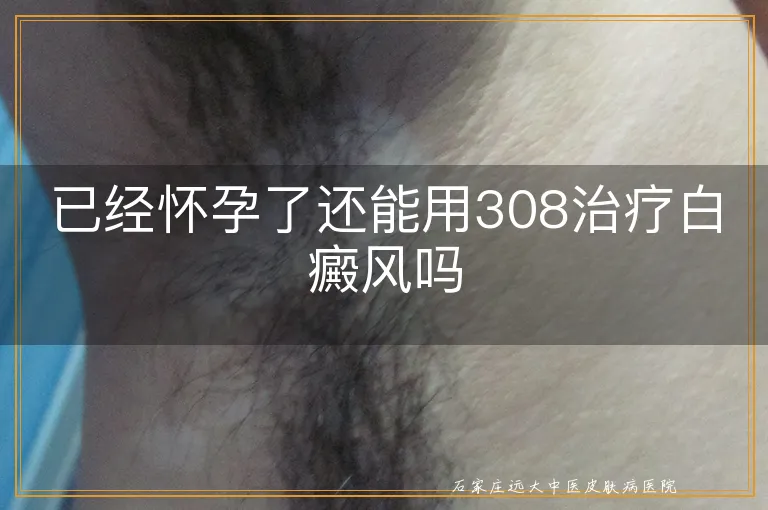 已经怀孕了还能用308治疗白癜风吗