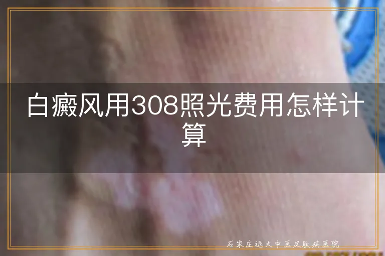 白癜风用308照光费用怎样计算