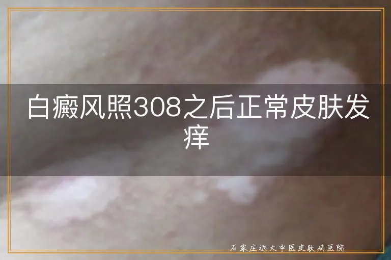 白癜风照308之后正常皮肤发痒