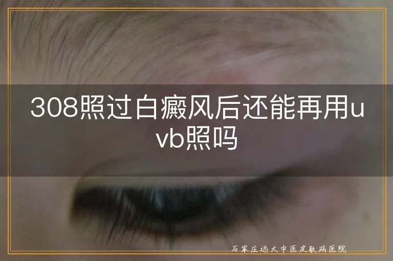 308照过白癜风后还能再用uvb照吗