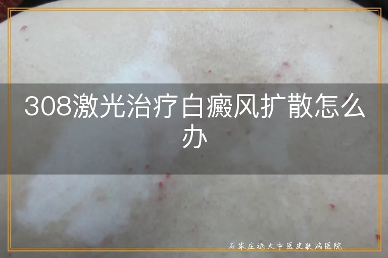 308激光治疗白癜风扩散怎么办