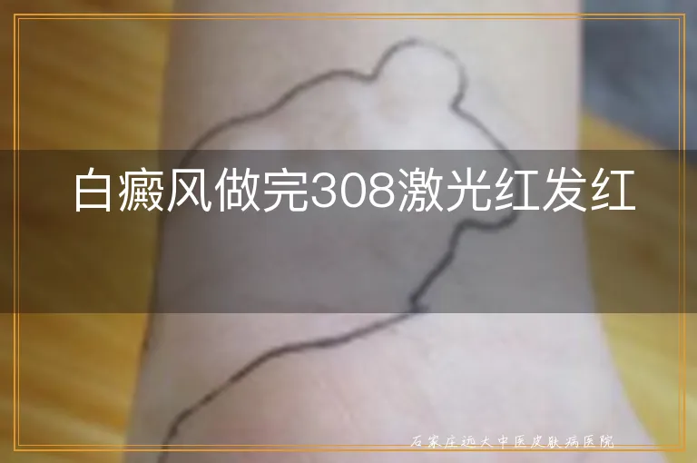 白癜风做完308激光红发红