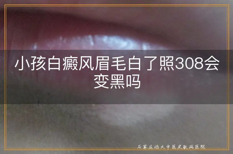 小孩白癜风眉毛白了照308会变黑吗