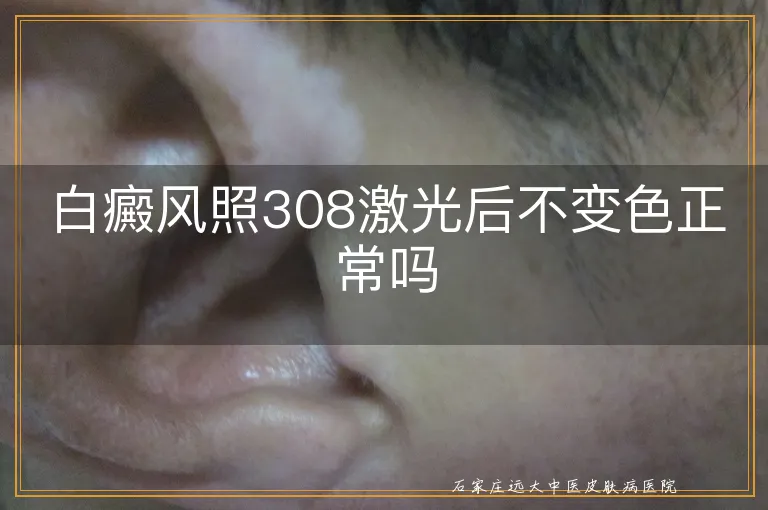 白癜风照308激光后不变色正常吗