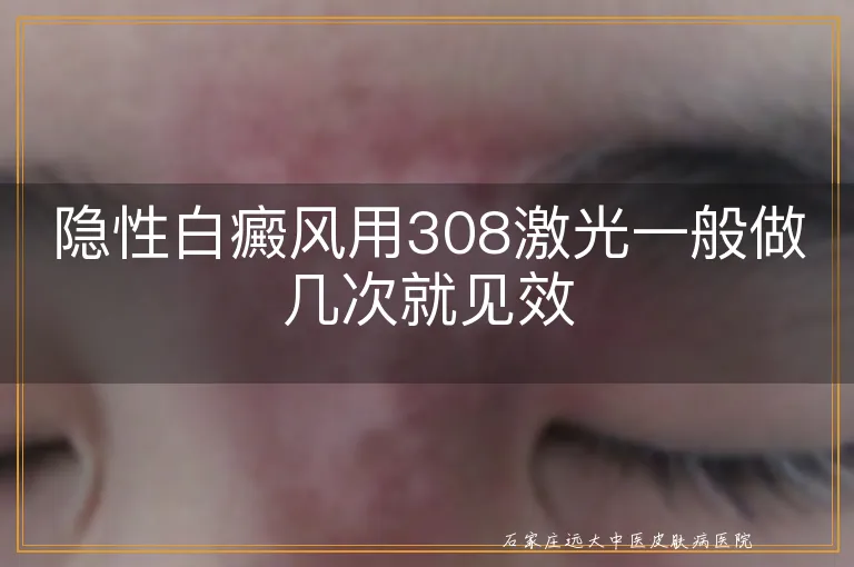 隐性白癜风用308激光一般做几次就见效