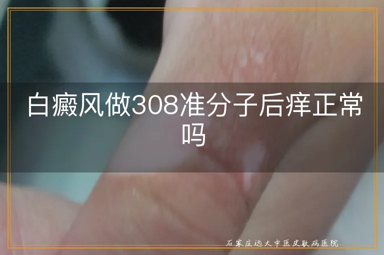 白癜风做308准分子后痒正常吗