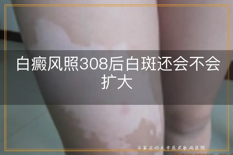 白癜风照308后白斑还会不会扩大