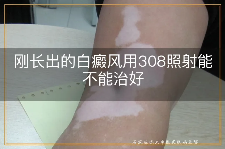 刚长出的白癜风用308照射能不能治好