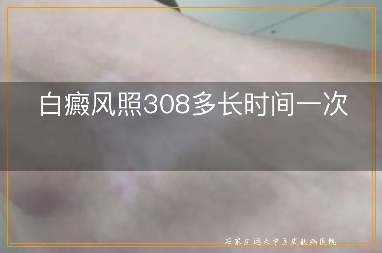 白癜风照308多长时间一次