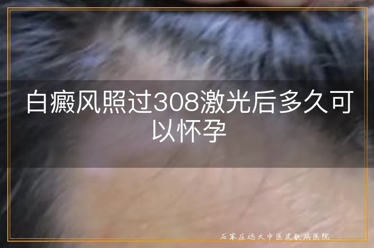 白癜风照过308激光后多久可以怀孕