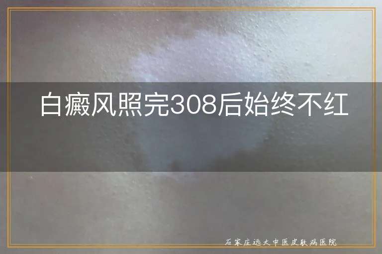 白癜风照完308后始终不红