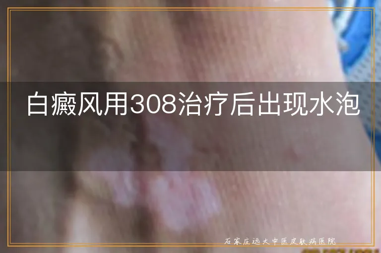 白癜风用308治疗后出现水泡