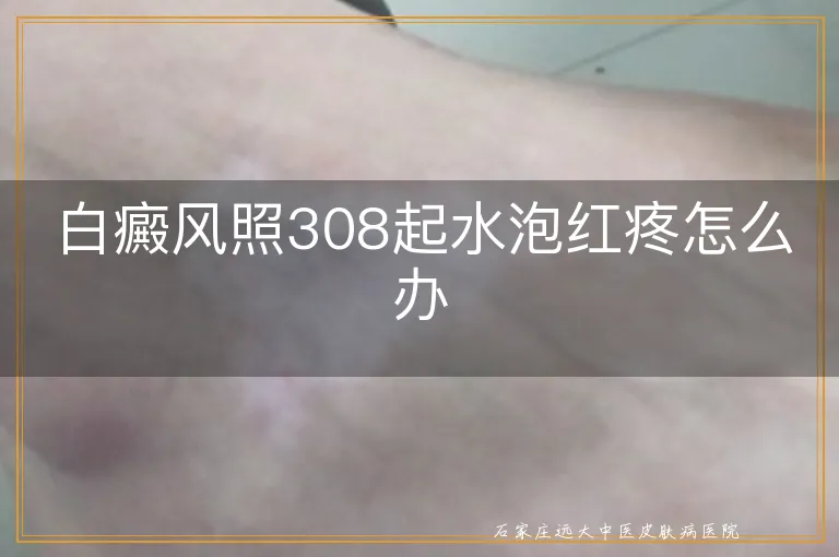 白癜风照308起水泡红疼怎么办