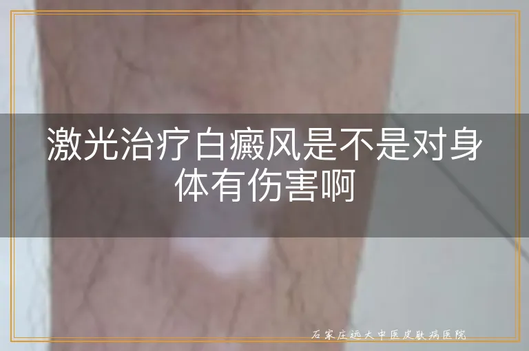 激光治疗白癜风是不是对身体有伤害啊