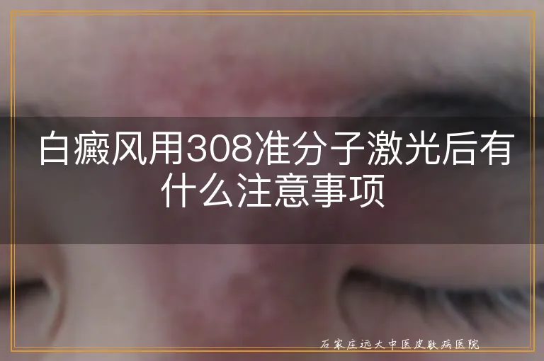 白癜风用308准分子激光后有什么注意事项