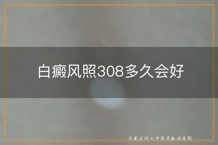 白癜风照308多久会好