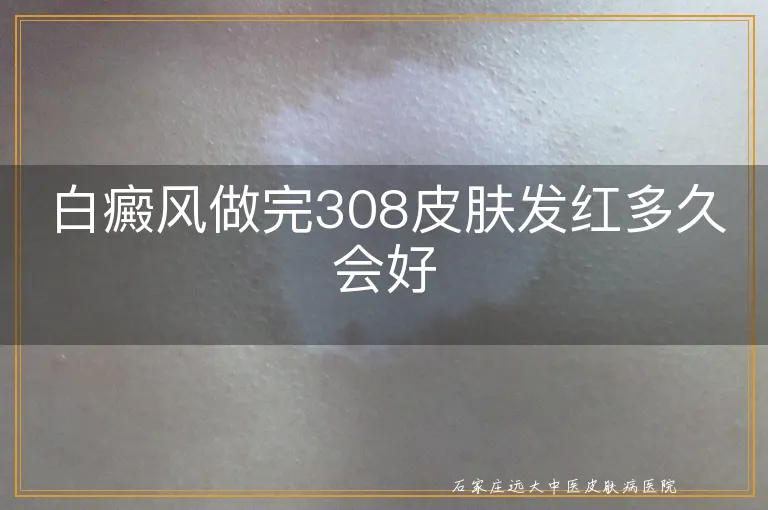 白癜风做完308皮肤发红多久会好