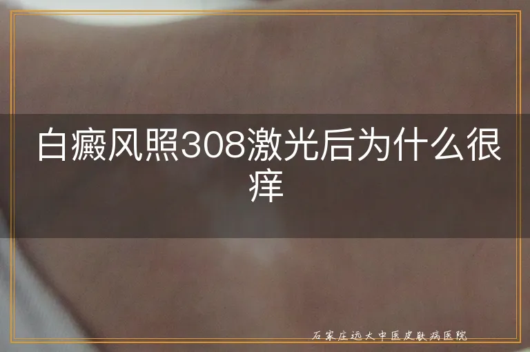 白癜风照308激光后为什么很痒