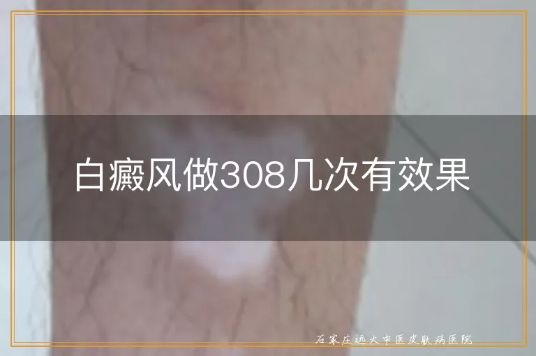 白癜风做308几次有效果