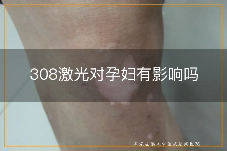 308激光对孕妇有影响吗