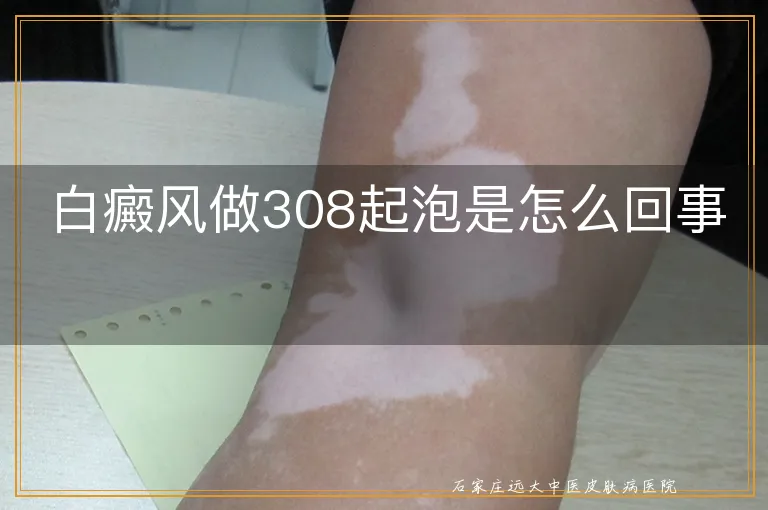 白癜风做308起泡是怎么回事