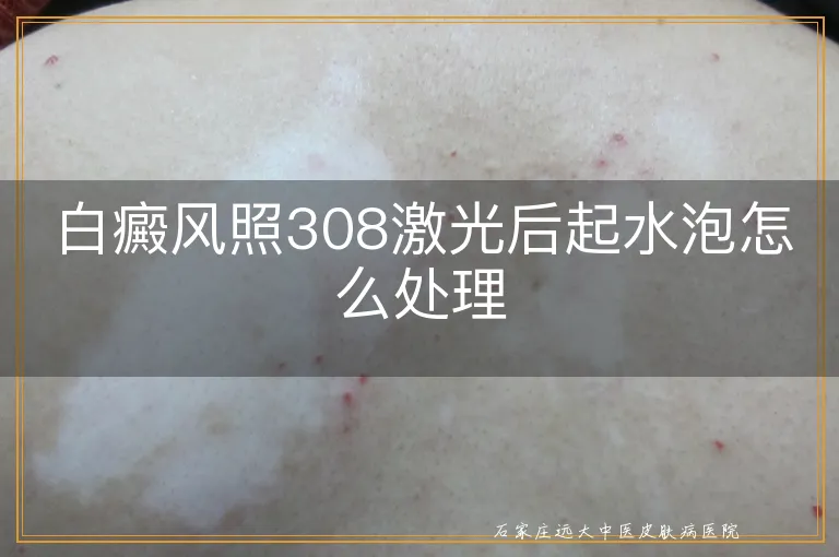 白癜风照308激光后起水泡怎么处理