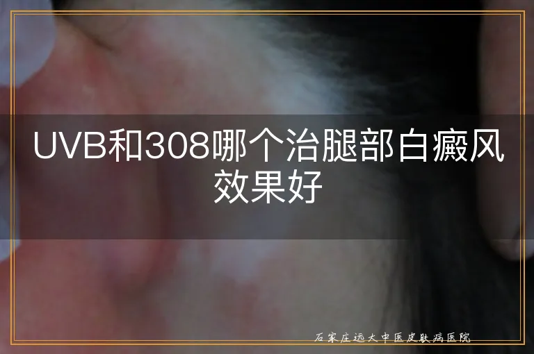 UVB和308哪个治腿部白癜风效果好