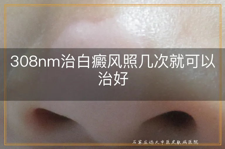 308nm治白癜风照几次就可以治好