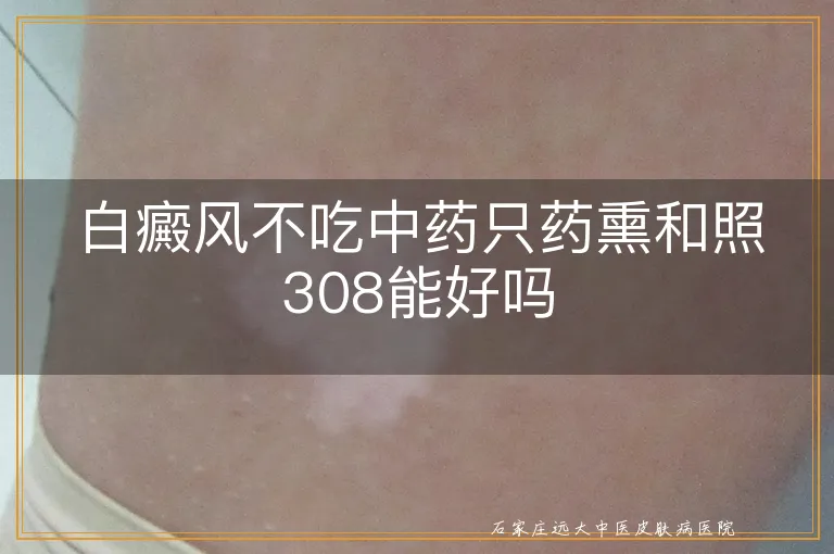 白癜风不吃中药只药熏和照308能好吗