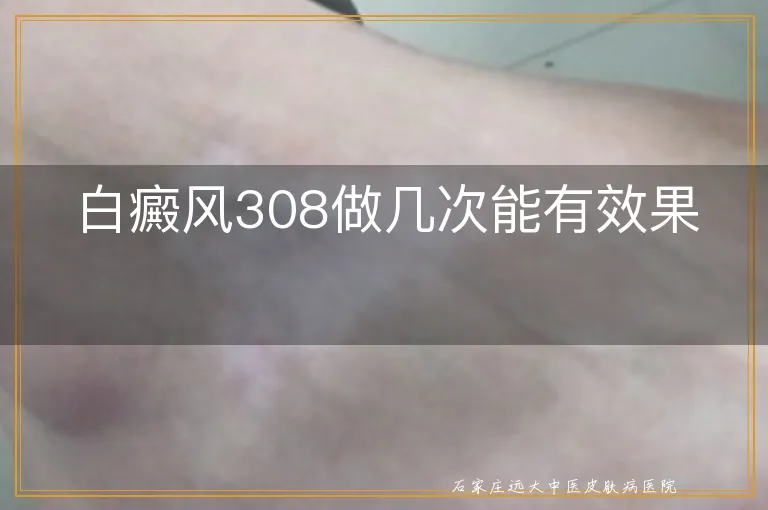 白癜风308做几次能有效果