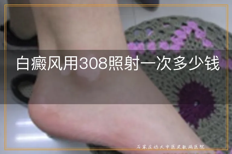 白癜风用308照射一次多少钱